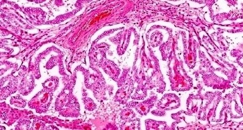 Thyroid Cancer Image