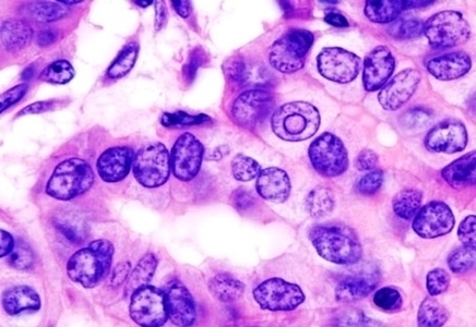Thyroid Papillary Carcinoma Histopathology Image