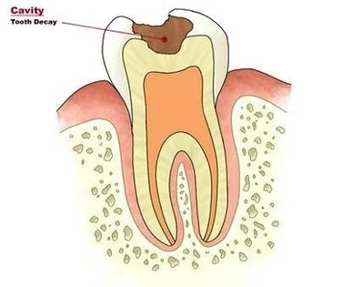 Tooth Cavity Image