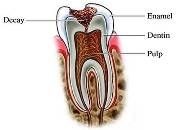 Tooth Decay Image