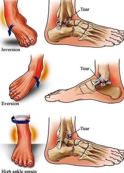 Types Of Ankle Sprains Image