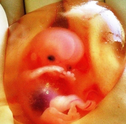 Week Fetal Fetus Image