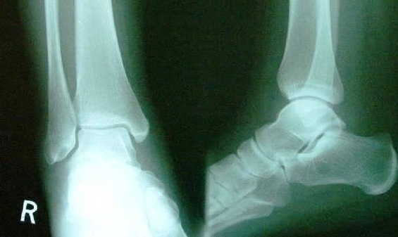 Xray Normal Ankle Image