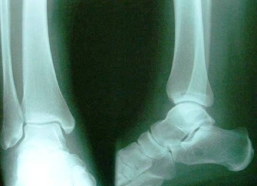 Xray Normal Ankle Pic Image