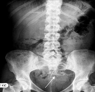 Xray Of Stomach Cancer Figure Image