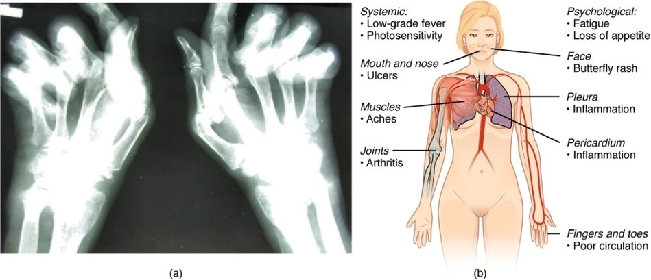 Autoimmune Disorders Rheumatoid Arthritis and Lupus
