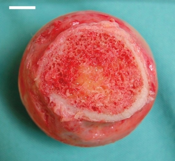 Bone Marrow