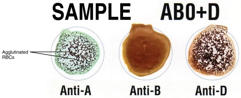 Cross Matching Blood Types