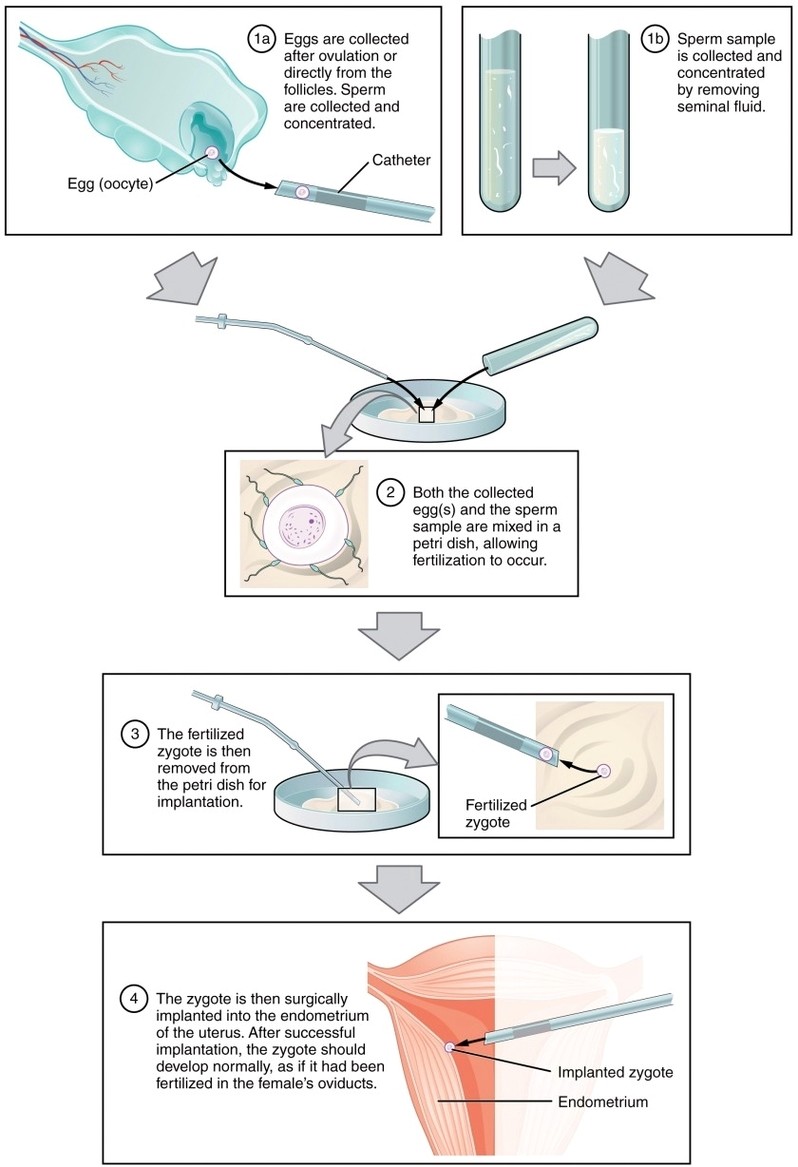 IVF