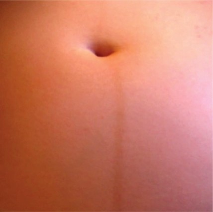 Photo of Linea Nigra