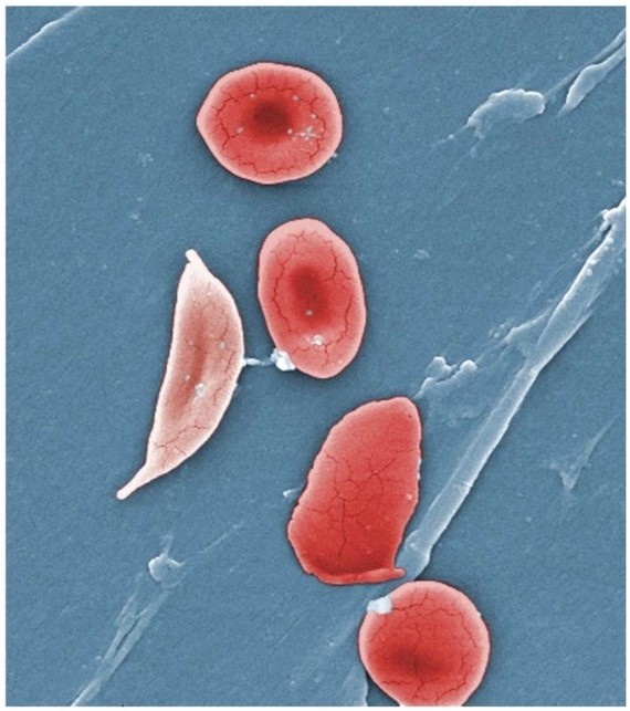 Sickle Cells