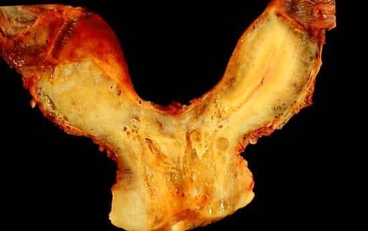 Bicornate Uterus Development of the Reproductive System