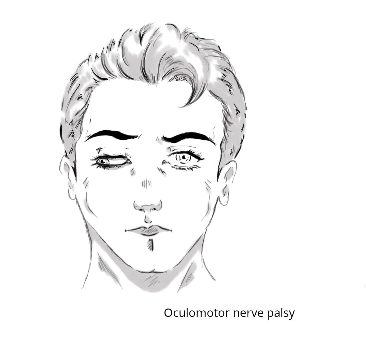 Oculomotor Nerve Palsy Down and Out Position