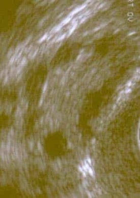 Ultrasound Polycystic Ovary Syndrome