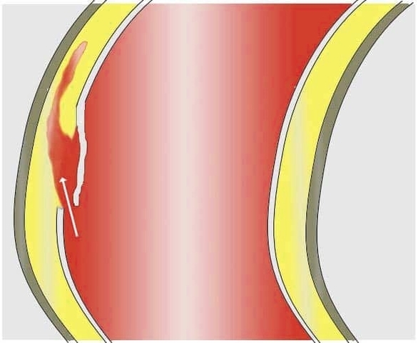 Aortic Dissection