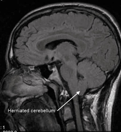 CT Scan of Cerebellar Tonsil Herniation