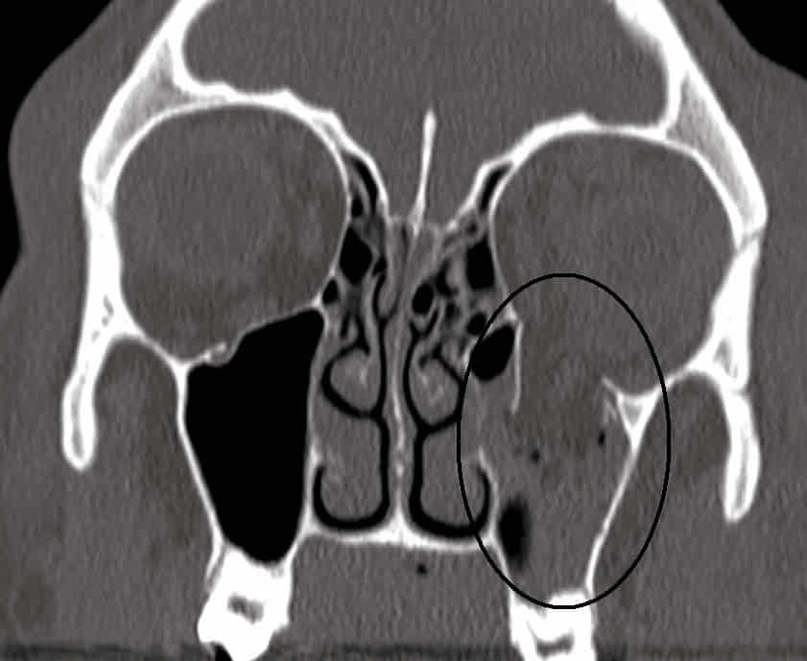 CT Scan of a Blowout Fracture of the Inferior Wall