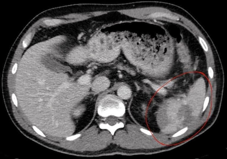 CT Scan of a Ruptured Spleen
