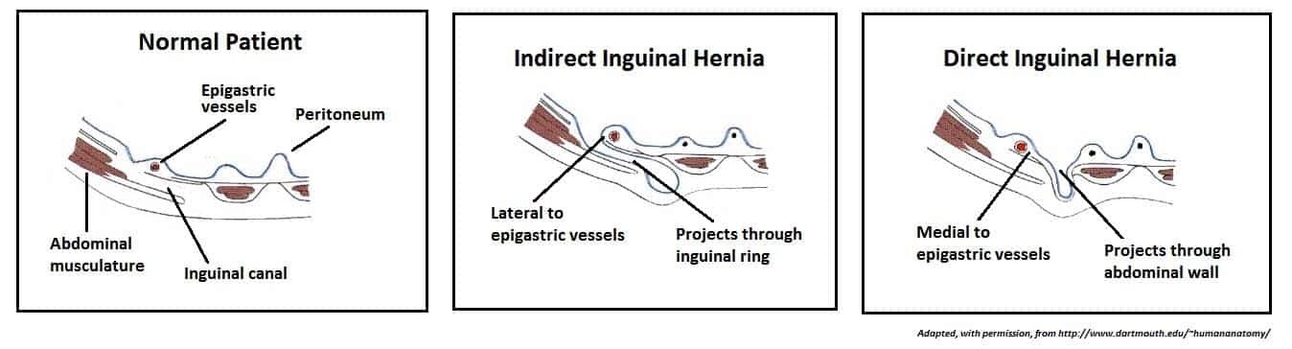 Direct Inguinal Hernia vs Indirect Inguinal Hernia Regional Anatomy