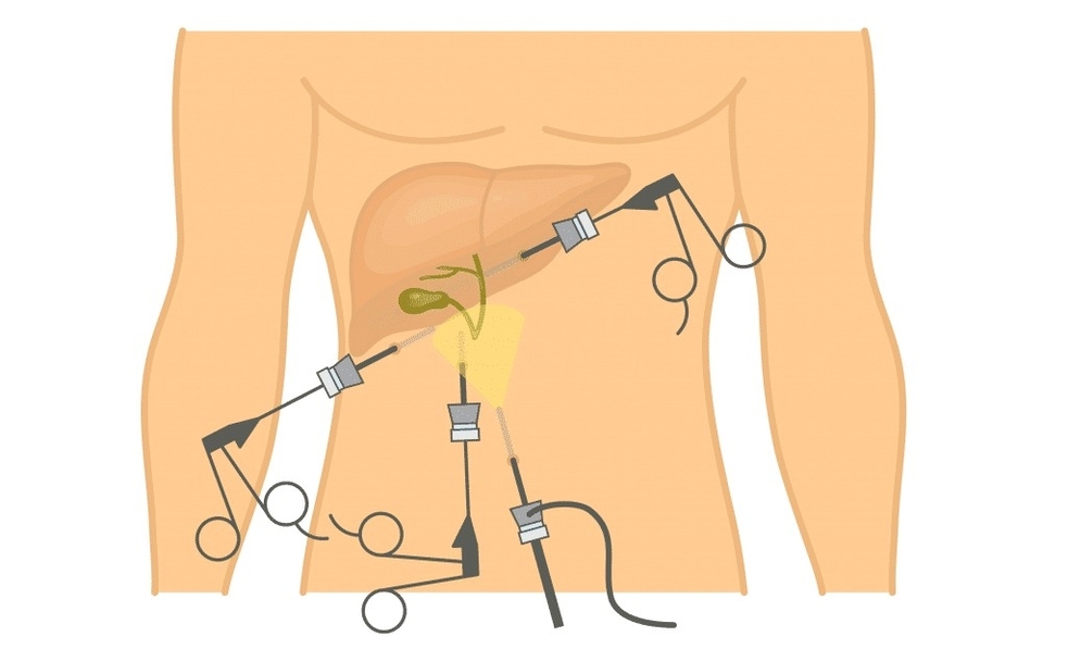 Laparoscopic Cholecystectomy