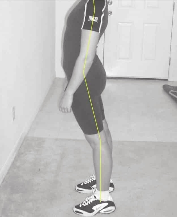Lordosis
