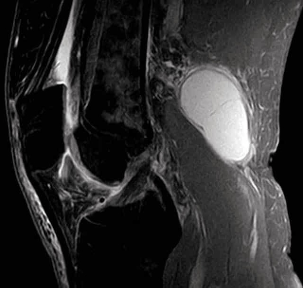 MRI Scan of a Bakers Cyst