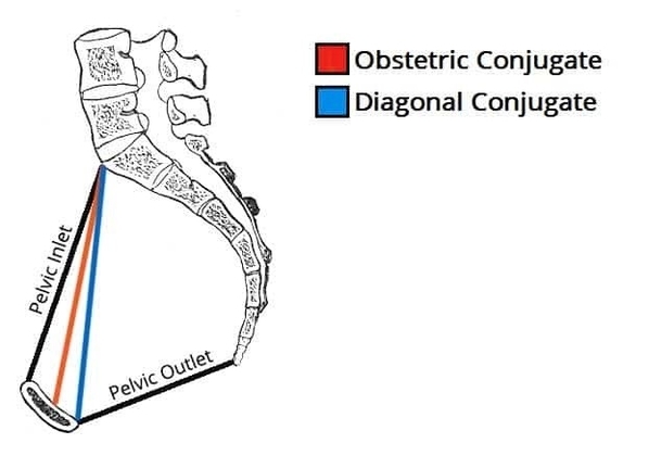 Measuring the Female Pelvis Obstetric and Diagonal Conjugates