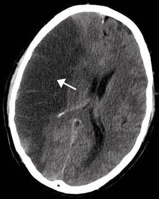 Middle Cerebral Artery Infarct