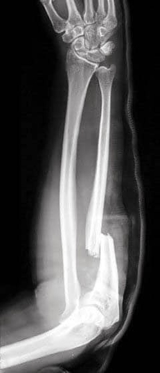 Monteggia Fracture of the Radius and Ulna