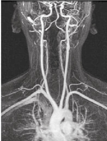Overview of Arterial Supply to the Brain Internal Carotid and Vertebral Arteries