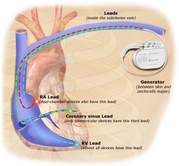 Pacemaker Illustration Conducting System of the Heart