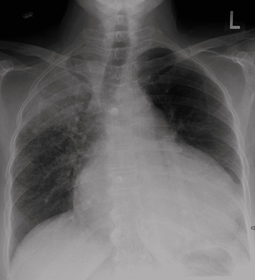Pericardial Tamponade
