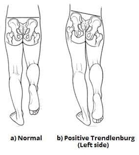 Positive Trendlenburg Test