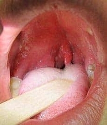 Quinsy Inflammation of Peritonsillar Tissue