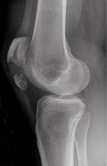 Radiograph of Fractured Patella