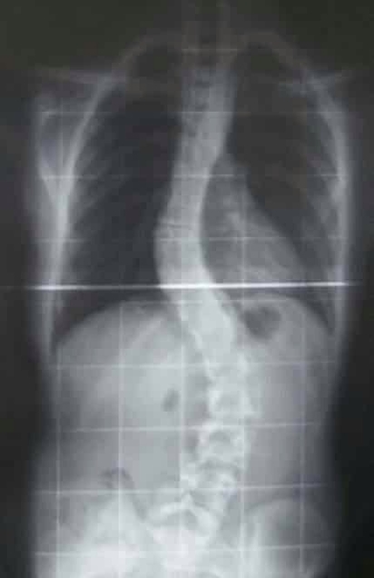 Radiograph of Scoliosis of the Spine