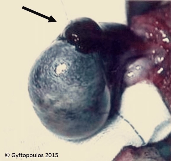 Testicular Torsion