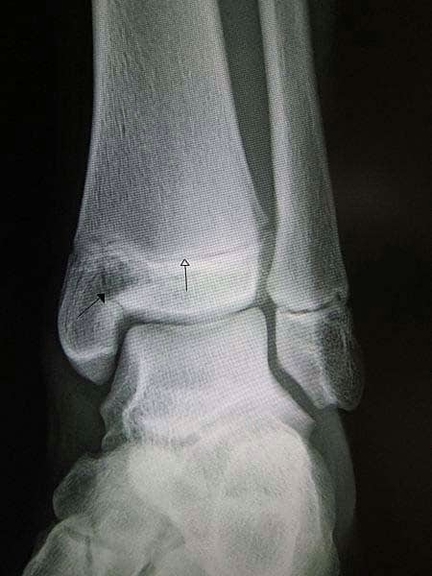 Trimalleolar Fracture of the Ankle Joint