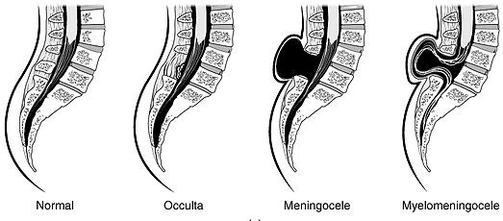 Types of Spina Bifida