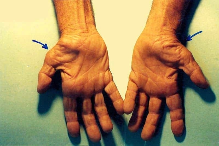Untreated CTS