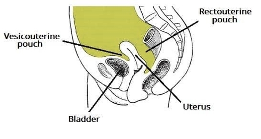 Vesicouterine and Rectouterine Pouches