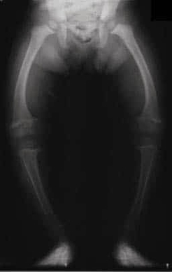 X Ray of Rickets