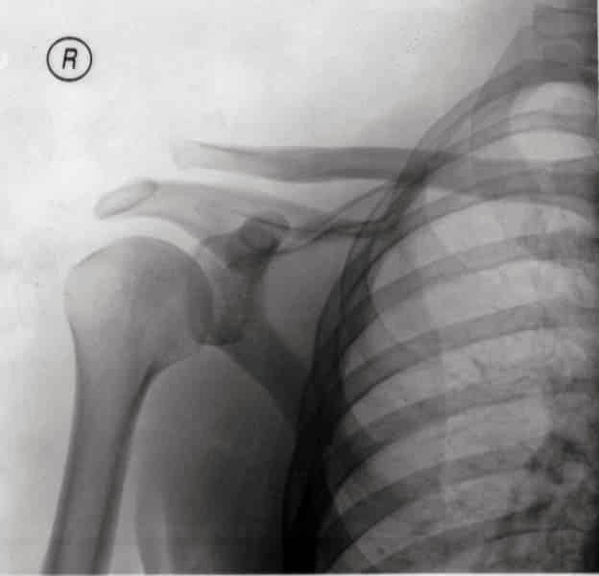 X Ray of Shoulder Separation
